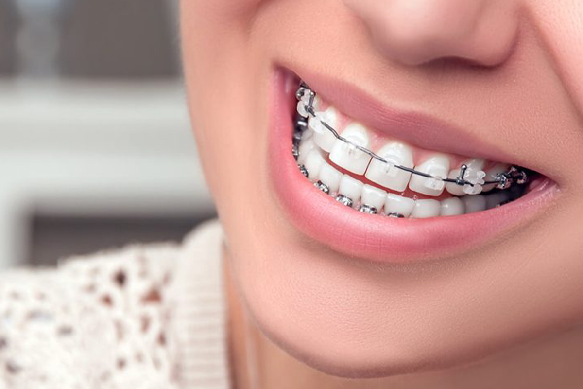 https://dentenay.com/wp-content/uploads/2025/06/ortodonti.jpg